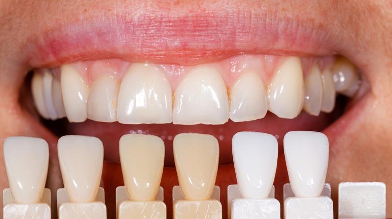 Veneers Los Angeles, CA